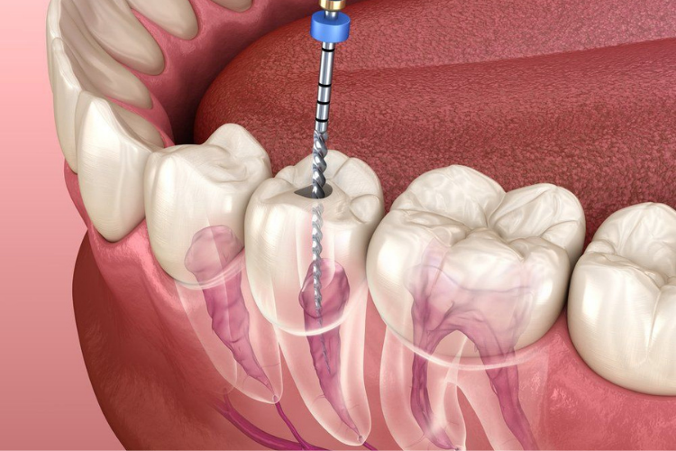 Root Canal Anatomy